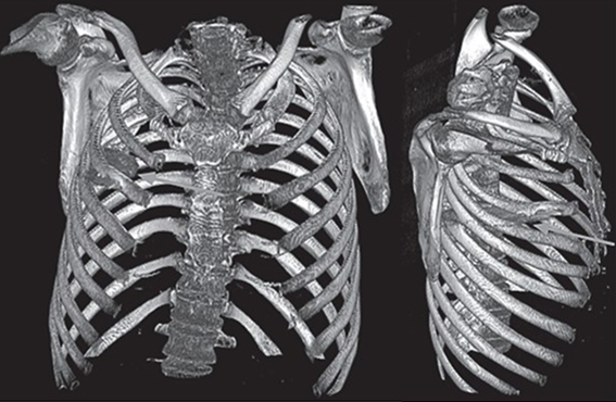 Doctors in Tanzania discovered a man had lived eight years with a knife blade in his chest after a violent altercation, removing it successfully and ensuring his full recovery.