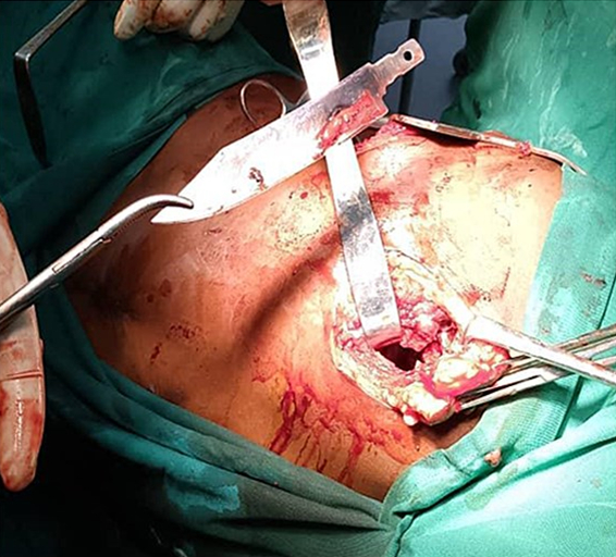 Doctors in Tanzania discovered a man had lived eight years with a knife blade in his chest after a violent altercation, removing it successfully and ensuring his full recovery.