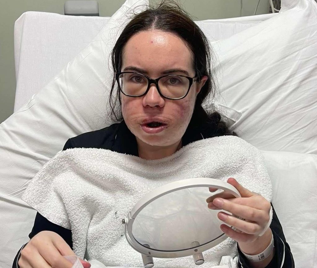 Shy woman with a severe underbite reveals life changing transformation after painful jaw surgery - eight years of braces and months of recovery left her unrecognisable.