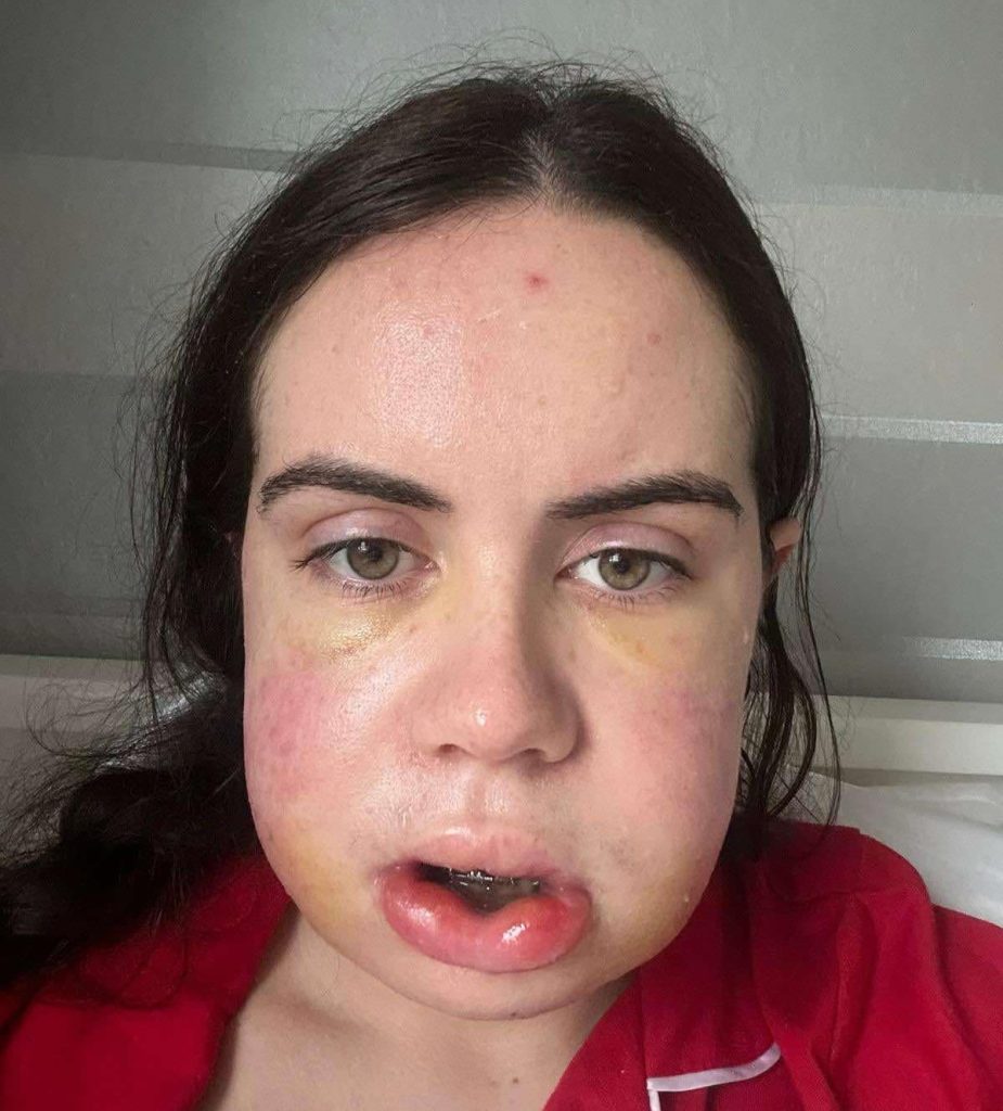 Shy woman with a severe underbite reveals life changing transformation after painful jaw surgery - eight years of braces and months of recovery left her unrecognisable.