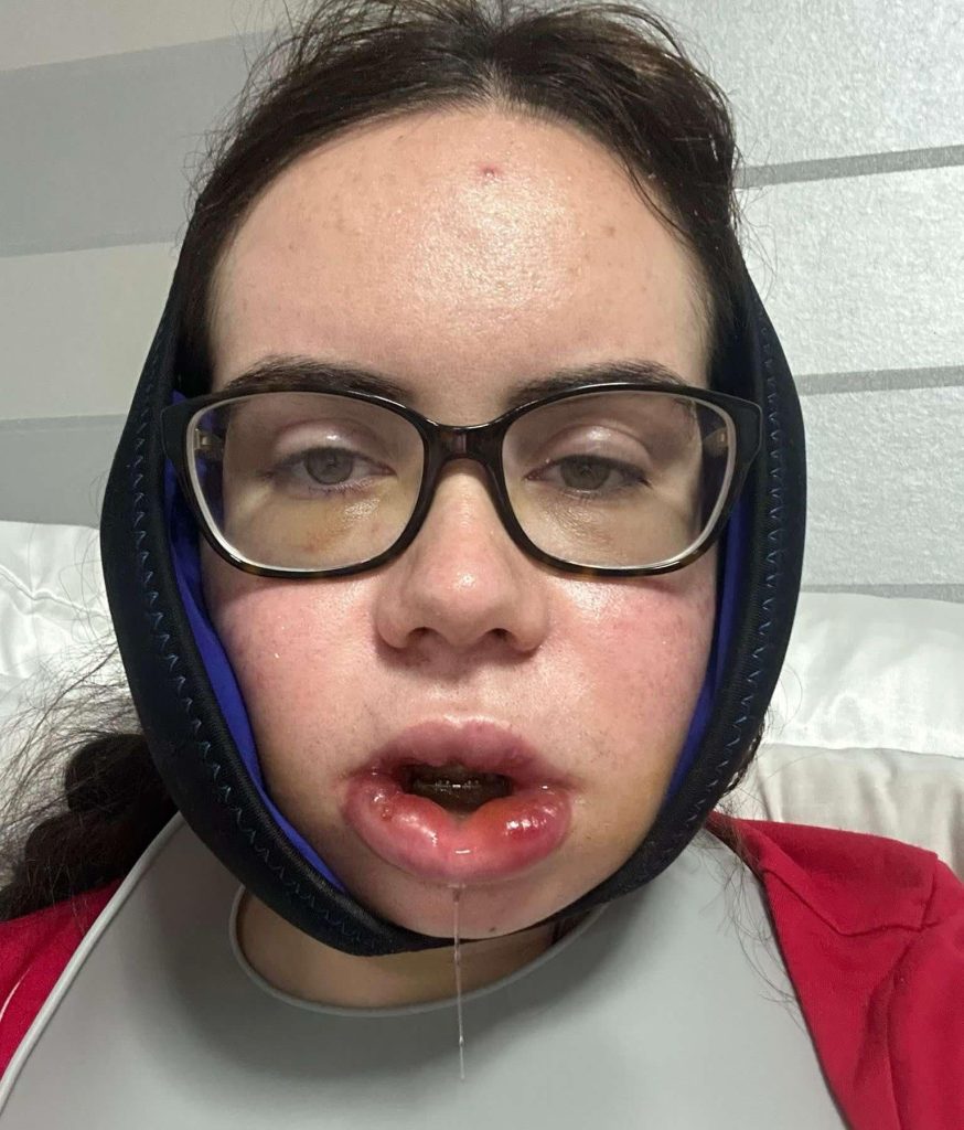 Shy woman with a severe underbite reveals life changing transformation after painful jaw surgery - eight years of braces and months of recovery left her unrecognisable.