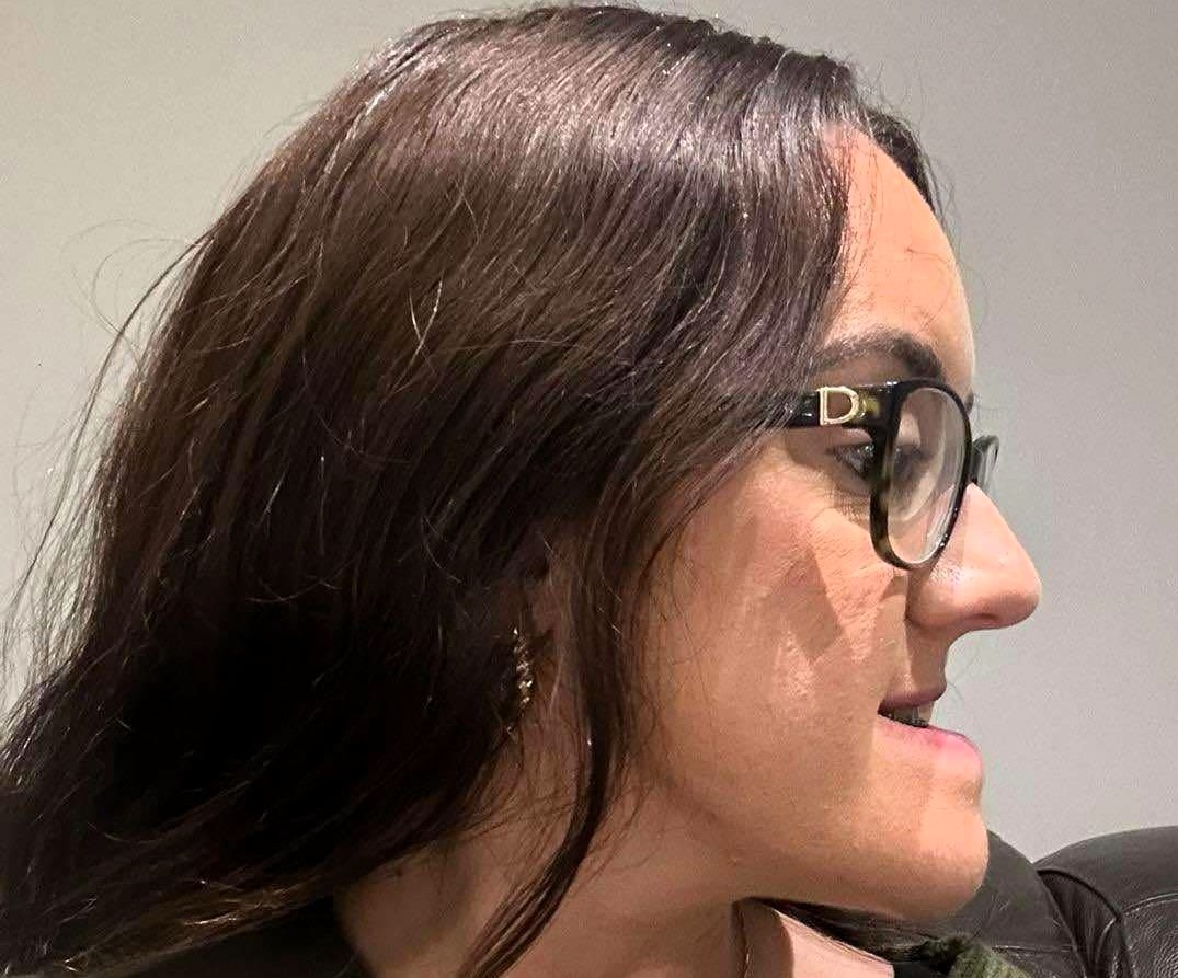 Shy woman with a severe underbite reveals life changing transformation after painful jaw surgery - eight years of braces and months of recovery left her unrecognisable.