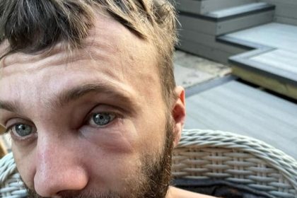 Dad of three Shane Samler reveals how his £2.2m cocaine addiction destroyed his health, collapsed his nose, and cost him his business - now he warns others.