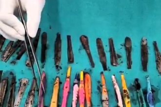 Doctors in India removed 29 spoons, 19 toothbrushes and 2 pens from a man’s stomach after he swallowed them in frustration at a rehab centre, leaving him in agony.
