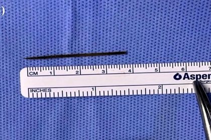 Man swallows toothpick in sleep causing severe abdominal pain and bowel perforation - doctors first suspected chicken bone before emergency surgery saved him.
