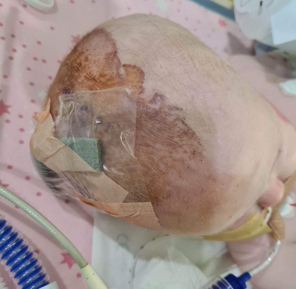 A mum is calling for more brain tumour research after her daughter Molly, 3, endured multiple surgeries and trials but now faces lifelong challenges and uncertainty.