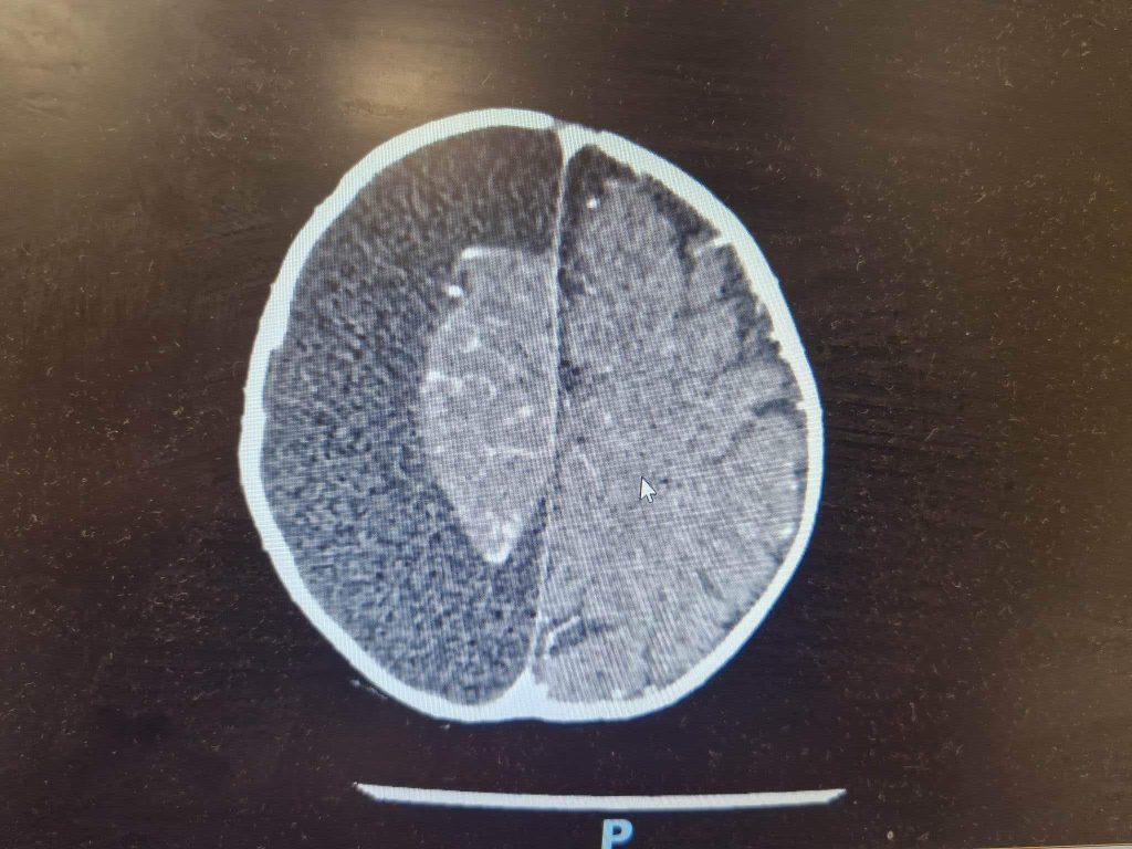 A mum is calling for more brain tumour research after her daughter Molly, 3, endured multiple surgeries and trials but now faces lifelong challenges and uncertainty.