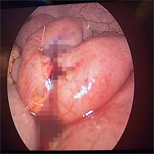 Doctors in Saudi Arabia removed a rubber baby bottle teat from a 10-year-old boy’s intestine after days of pain and vomiting, leaving medics stunned by the bizarre case.