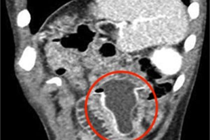 Doctors in Saudi Arabia removed a rubber baby bottle teat from a 10-year-old boy’s intestine after days of pain and vomiting, leaving medics stunned by the bizarre case.