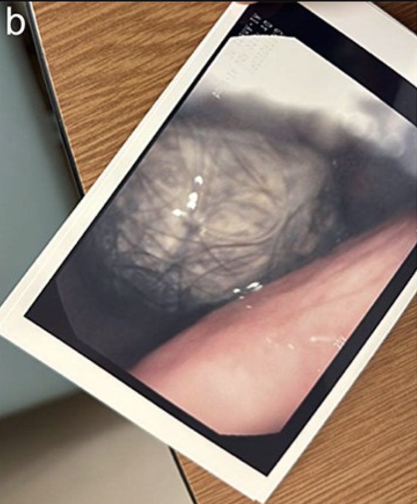 Doctors discover massive hairball in stomach of 17-year-old with Rapunzel syndrome after years of eating hair. Teen undergoes surgery and begins therapy for recovery.