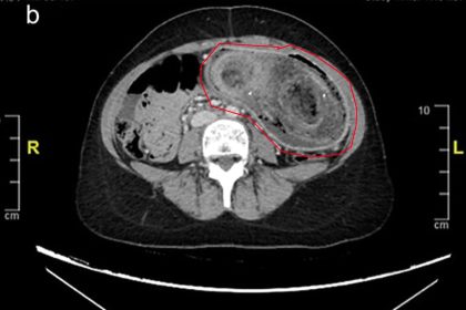 Doctors discover massive hairball in stomach of 17-year-old with Rapunzel syndrome after years of eating hair. Teen undergoes surgery and begins therapy for recovery.