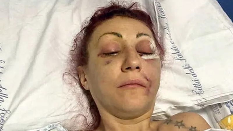 Judge sparks outrage after acquitting a man who brutally beat his estranged wife, leaving her with 21 titanium plates and blindness in one eye, calling it “understandable”.