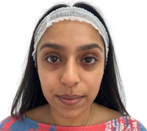UK clinic launches salmon sperm treatment to reduce scars and stretch marks - Dr Leah’s polynucleotide therapy boosts collagen for firmer skin and natural results.