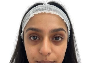 UK clinic launches salmon sperm treatment to reduce scars and stretch marks - Dr Leah’s polynucleotide therapy boosts collagen for firmer skin and natural results.