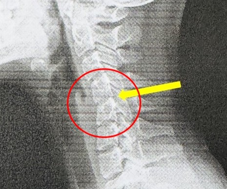 Doctor warns after 20-year-old develops “text neck” from excessive phone use - premature spine damage linked to heavy smartphone posture with long-term health risks.