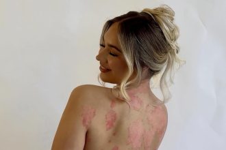 Rosie Daniels found relief from painful psoriasis after moving from gloomy Manchester to sunny Australia, where a calmer lifestyle and warmer climate eased her symptoms.