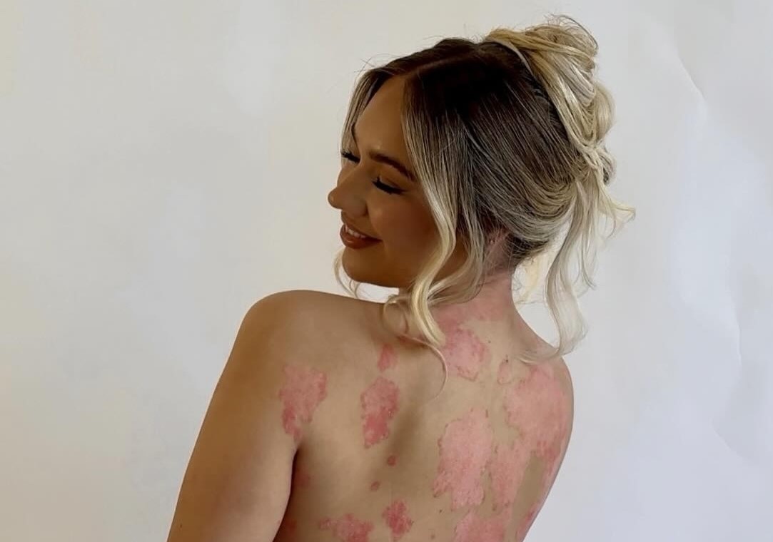 Rosie Daniels found relief from painful psoriasis after moving from gloomy Manchester to sunny Australia, where a calmer lifestyle and warmer climate eased her symptoms.
