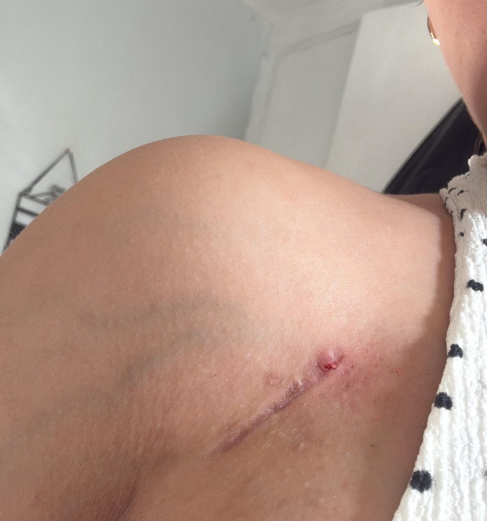 Doctors dismissed 23-year-old Leah Kalkan’s pain as “meat sweats” before scans abroad revealed a grapefruit-sized spinal tumour. She beat rare cancer after months of treatment.