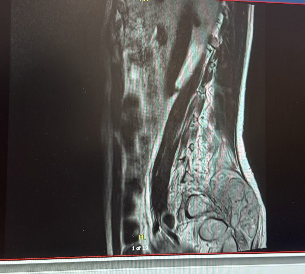 Doctors dismissed 23-year-old Leah Kalkan’s pain as “meat sweats” before scans abroad revealed a grapefruit-sized spinal tumour. She beat rare cancer after months of treatment.