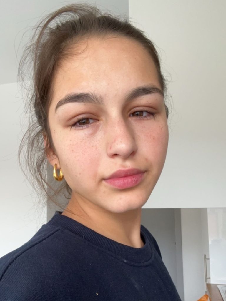 Doctors dismissed 23-year-old Leah Kalkan’s pain as “meat sweats” before scans abroad revealed a grapefruit-sized spinal tumour. She beat rare cancer after months of treatment.