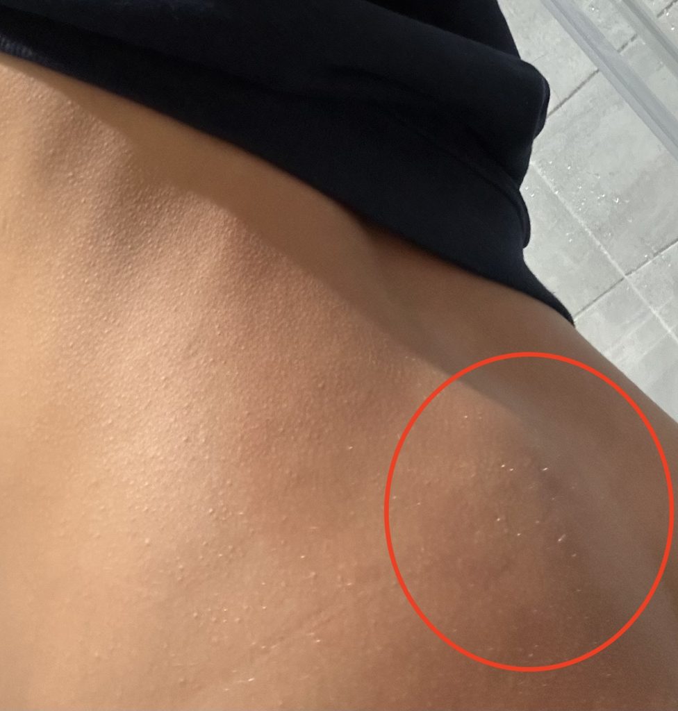 Doctors dismissed 23-year-old Leah Kalkan’s pain as “meat sweats” before scans abroad revealed a grapefruit-sized spinal tumour. She beat rare cancer after months of treatment.