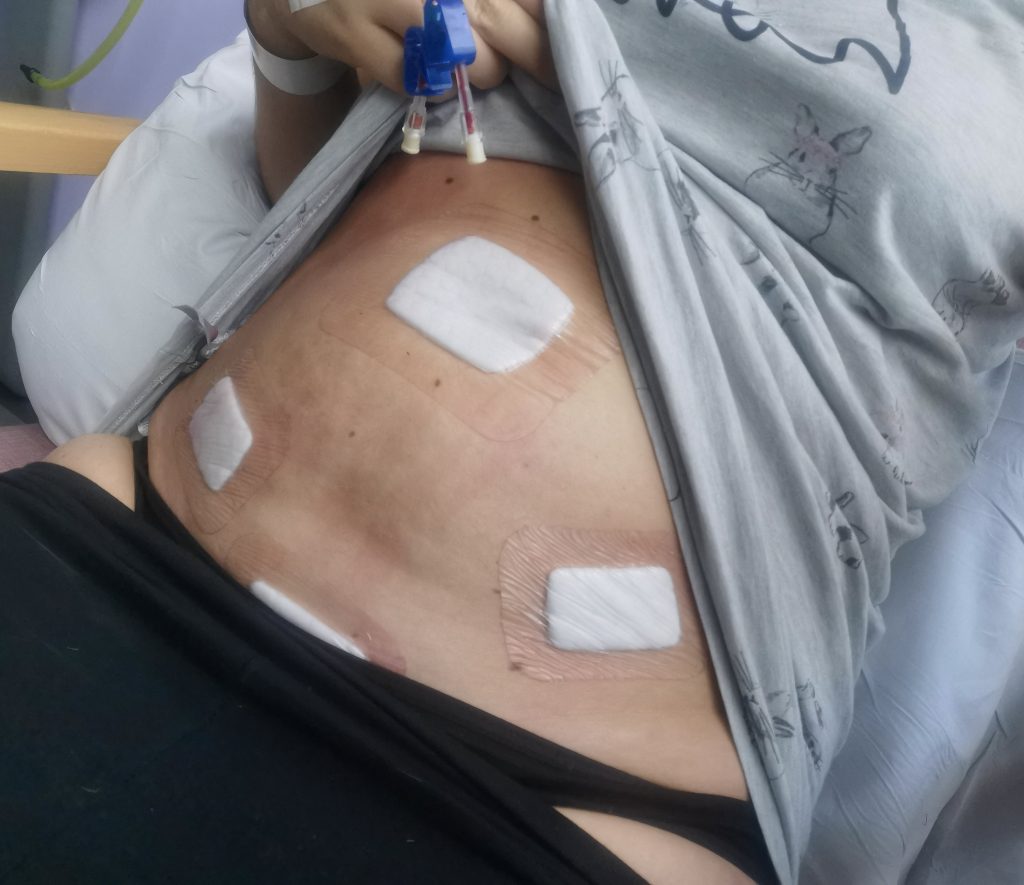 Brave mum Carla Blanksby went through menopause in her twenties to cure crippling PMDD pain - now she has the body of a 50 year old but says life feels brand new.