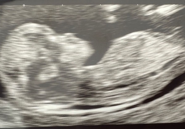 Mum’s warning after baby diagnosed with ultra rare ticking time bomb condition - One year old Jack is the only known UK case of a PPFIBP1 mutation with no cure.