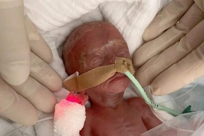 A baby girl born four months early and weighing just 0.7lbs has defied the odds to survive in Germany after weeks on a ventilator in what doctors call a medical miracle.