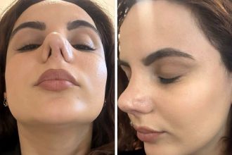 Alina Adiklhanyan, 29, says three botched nose jobs left her unable to breathe and suffering constant infections, as she searches abroad for a specialist to repair the damage.