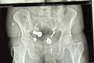 Doctors in India were shocked to find a wristwatch, nuts and bolts inside a man’s stomach, forcing surgeons to perform a three-hour operation to remove the bizarre metal objects.
