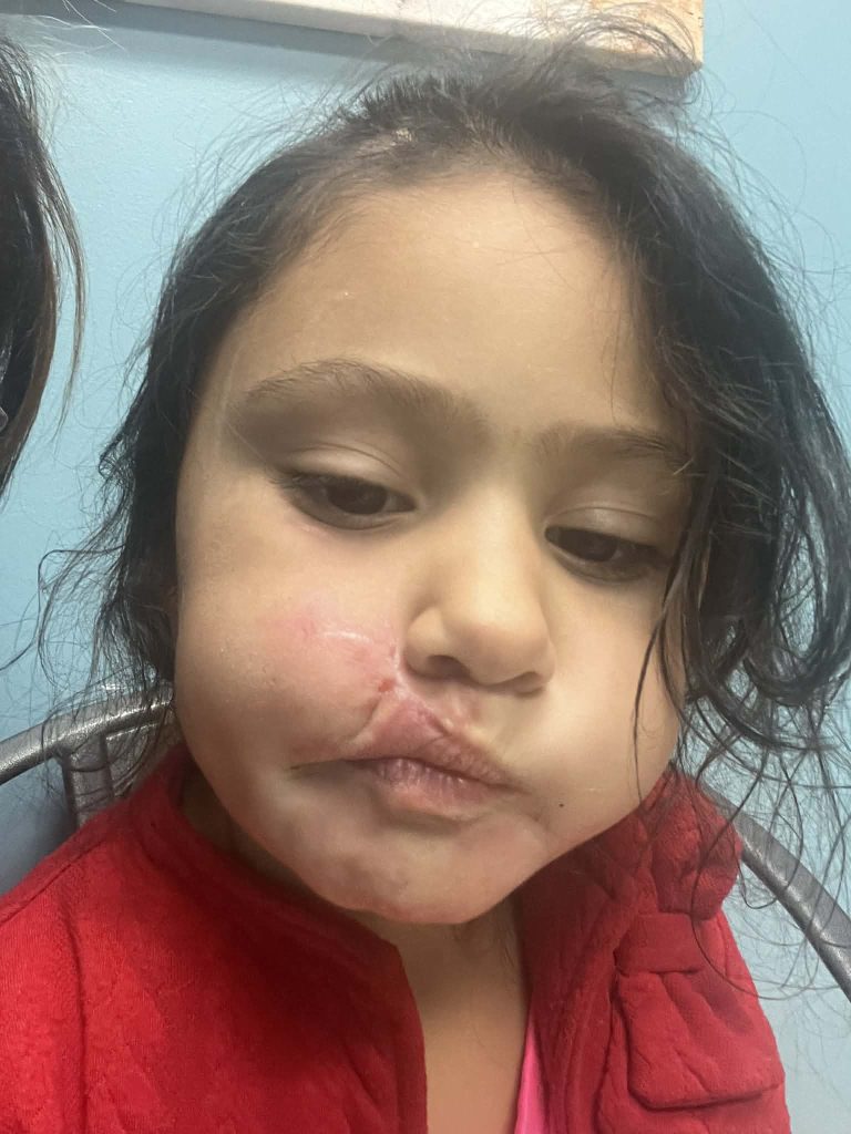 A brave mum fought off a pit bull with a plant pot after it mauled her four-year-old daughter leaving the child with severe facial injuries and lasting trauma.