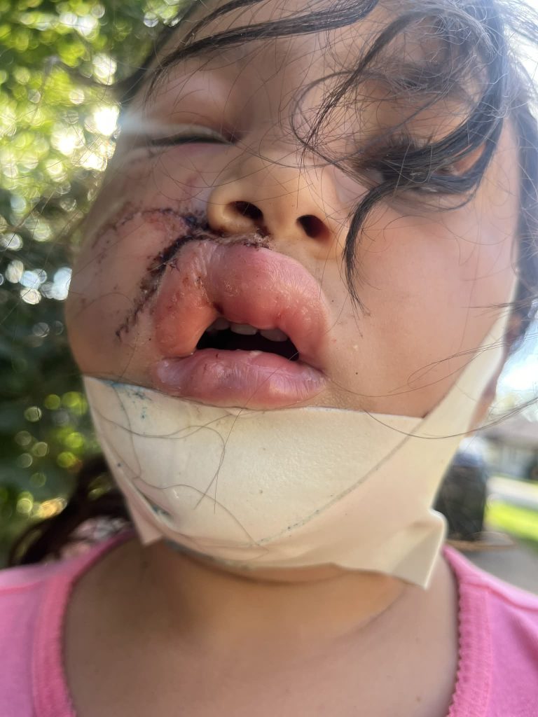 A brave mum fought off a pit bull with a plant pot after it mauled her four-year-old daughter leaving the child with severe facial injuries and lasting trauma.
