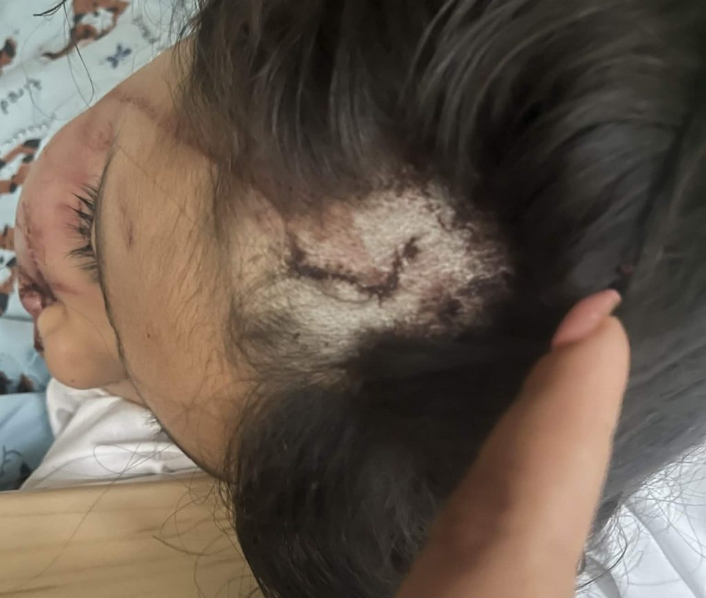 A brave mum fought off a pit bull with a plant pot after it mauled her four-year-old daughter leaving the child with severe facial injuries and lasting trauma.