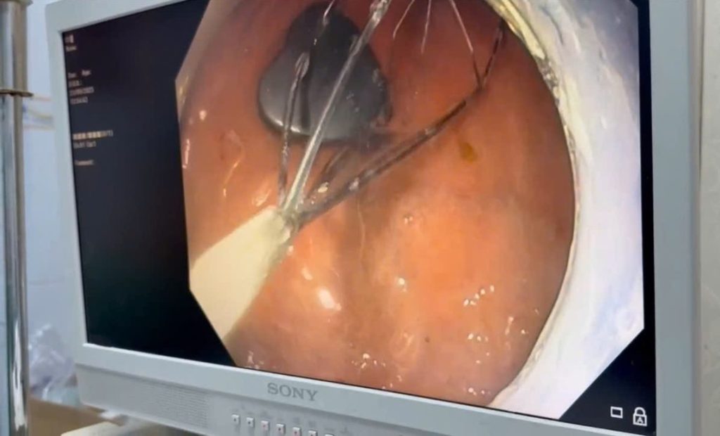Doctors in Vietnam removed a heart shaped magnet from a six year old boy’s stomach after he accidentally swallowed it with quick intervention preventing serious harm.