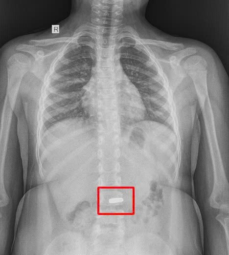 Doctors in Vietnam removed a heart shaped magnet from a six year old boy’s stomach after he accidentally swallowed it with quick intervention preventing serious harm.