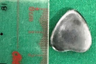 Doctors in Vietnam removed a heart shaped magnet from a six year old boy’s stomach after he accidentally swallowed it with quick intervention preventing serious harm.
