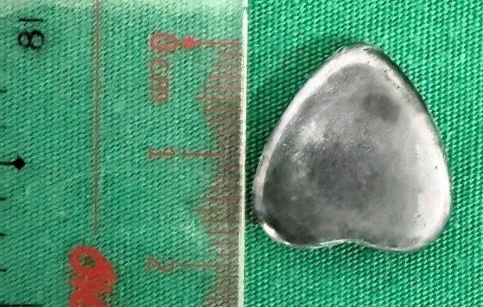 Doctors in Vietnam removed a heart shaped magnet from a six year old boy’s stomach after he accidentally swallowed it with quick intervention preventing serious harm.
