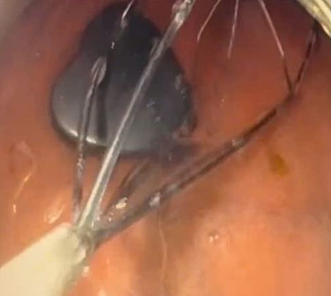 Doctors in Vietnam removed a heart shaped magnet from a six year old boy’s stomach after he accidentally swallowed it with quick intervention preventing serious harm.