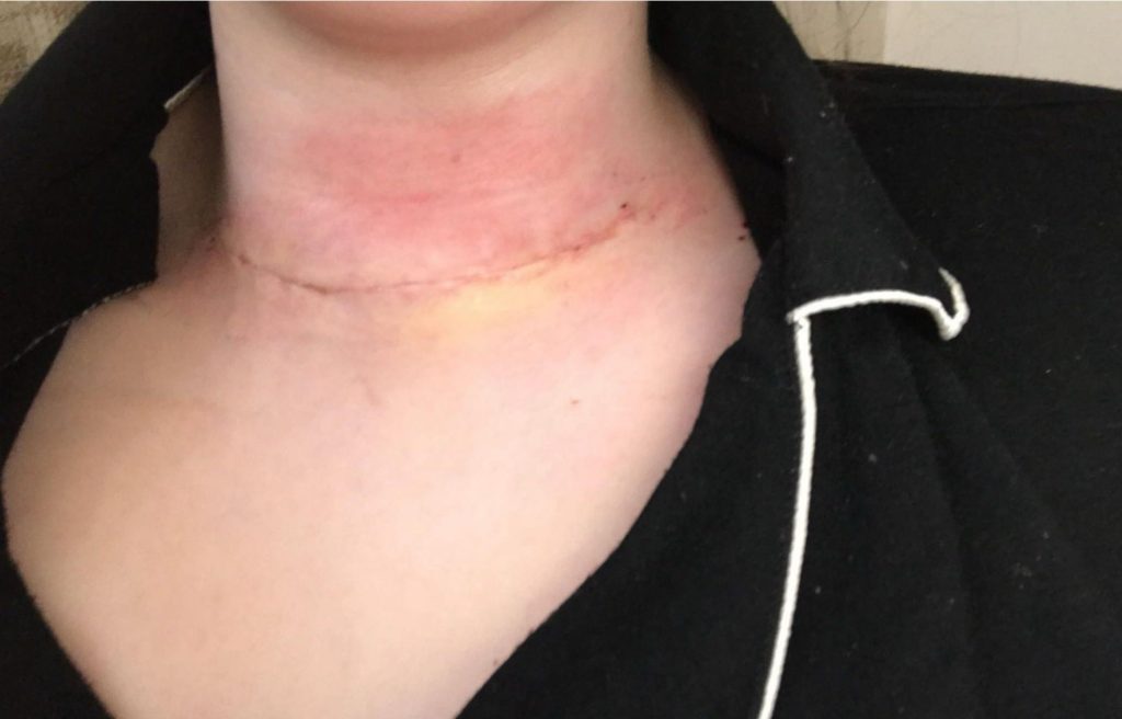 Becky Bowes discovered a hidden neck lump was thyroid cancer that spread to her lungs - now she urges others to check their necks regularly before it’s too late.