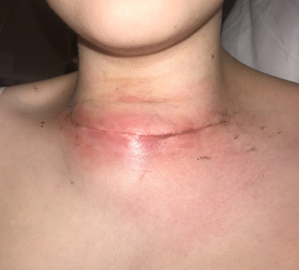 Becky Bowes discovered a hidden neck lump was thyroid cancer that spread to her lungs - now she urges others to check their necks regularly before it’s too late.