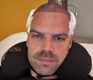 Love Island star Dominic Lever revealed his new look after a hair transplant in Turkey costing up to £4,300. The 32-year-old firefighter says he’s thrilled with the results.