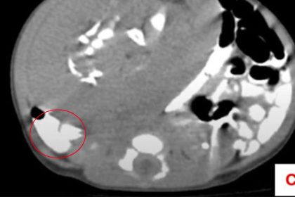 Doctors in Egypt discovered a parasitic twin inside a newborn’s abdomen after her stomach swelled. Surgeons removed the mass containing limbs, bones and an umbilical cord.