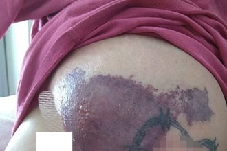 A new mum was left terrified after her breast turned black from necrotic erysipelas - a rare infection caused by bacteria after childbirth - requiring multiple surgeries and a skin graft.