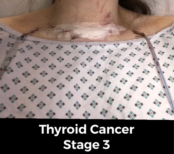 Becky Bowes, 25, was diagnosed with thyroid cancer that spread to her lungs after doctors found a hidden lump in her neck, leaving her battling fatigue and life-changing effects.