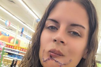 Minna Pickell was left traumatised after a stray dog ripped off her bottom lip in a brutal park attack, leaving her needing major reconstructive surgery and battling PTSD.