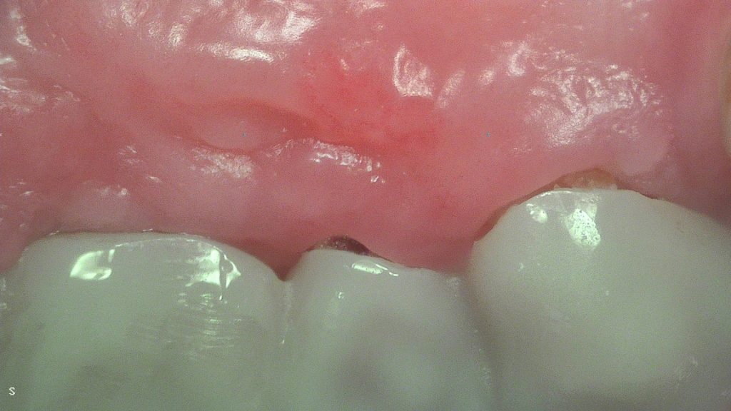 A woman awarded £17000 after a botched dental bridge left her in agony says four healthy teeth were drilled unnecessarily leaving her disfigured and terrified of dentists.