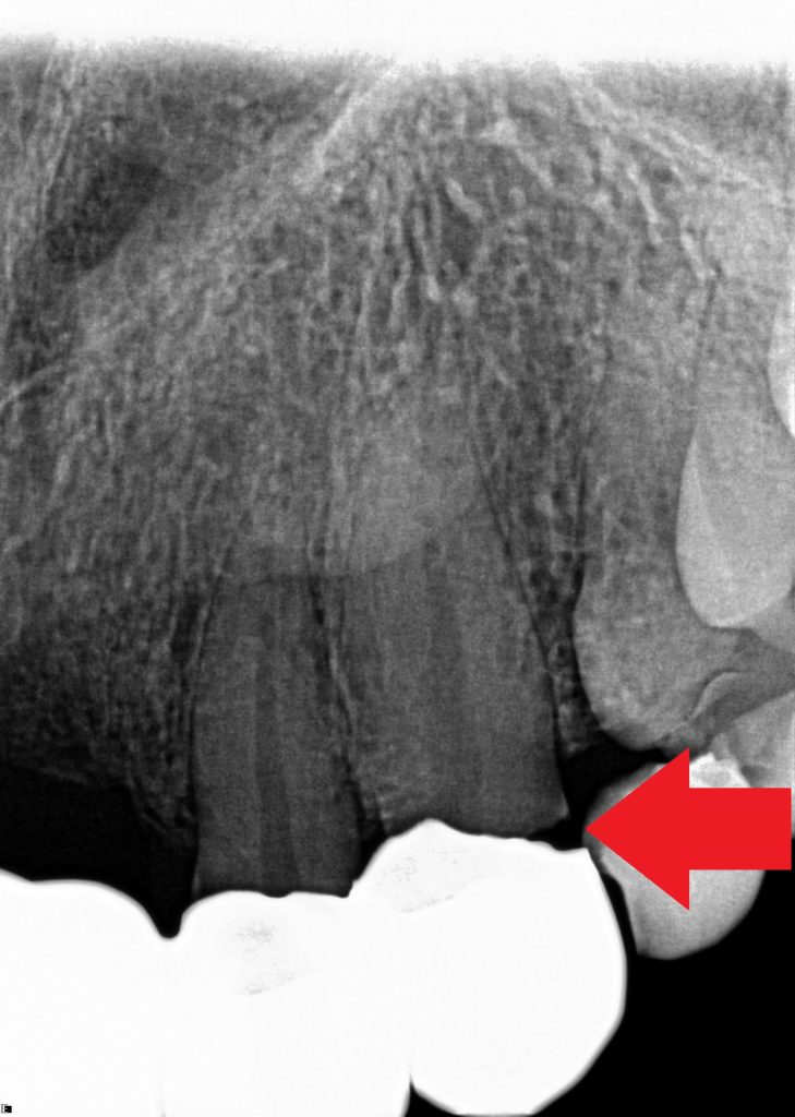 A woman awarded £17000 after a botched dental bridge left her in agony says four healthy teeth were drilled unnecessarily leaving her disfigured and terrified of dentists.