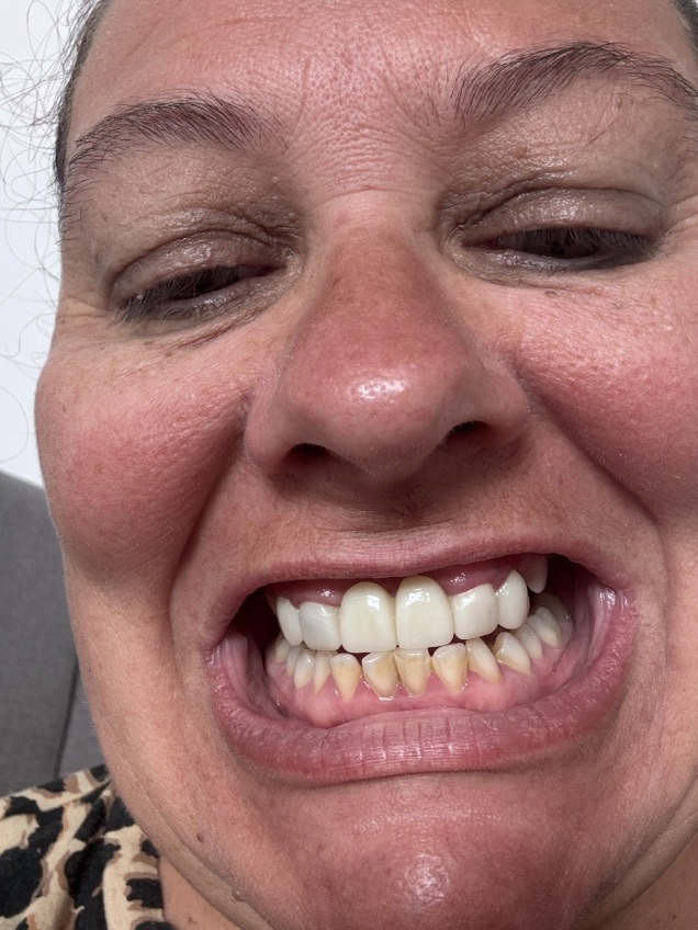 A woman awarded £17000 after a botched dental bridge left her in agony says four healthy teeth were drilled unnecessarily leaving her disfigured and terrified of dentists.