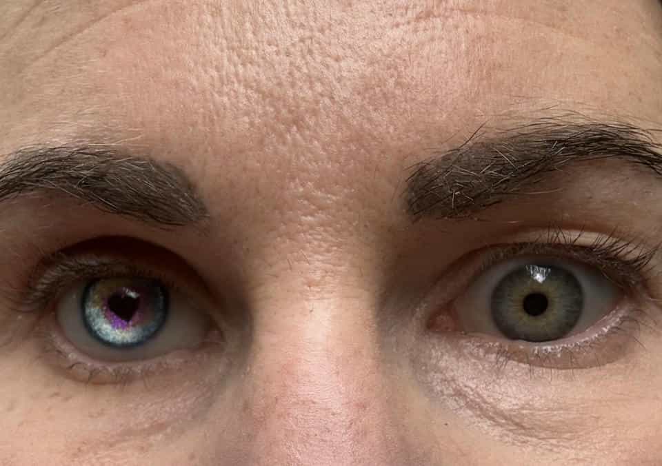 A mum from Alton had her eye removed after a trainee optician at Specsavers spotted a rare ocular melanoma during a routine test, saving her life with early detection.