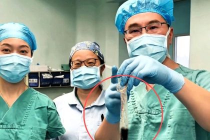 Chinese doctors remove a cigarette lighter swallowed 30 years ago using a condom after forceps failed as the patient finally sought help for pain revealing the bizarre long hidden object.